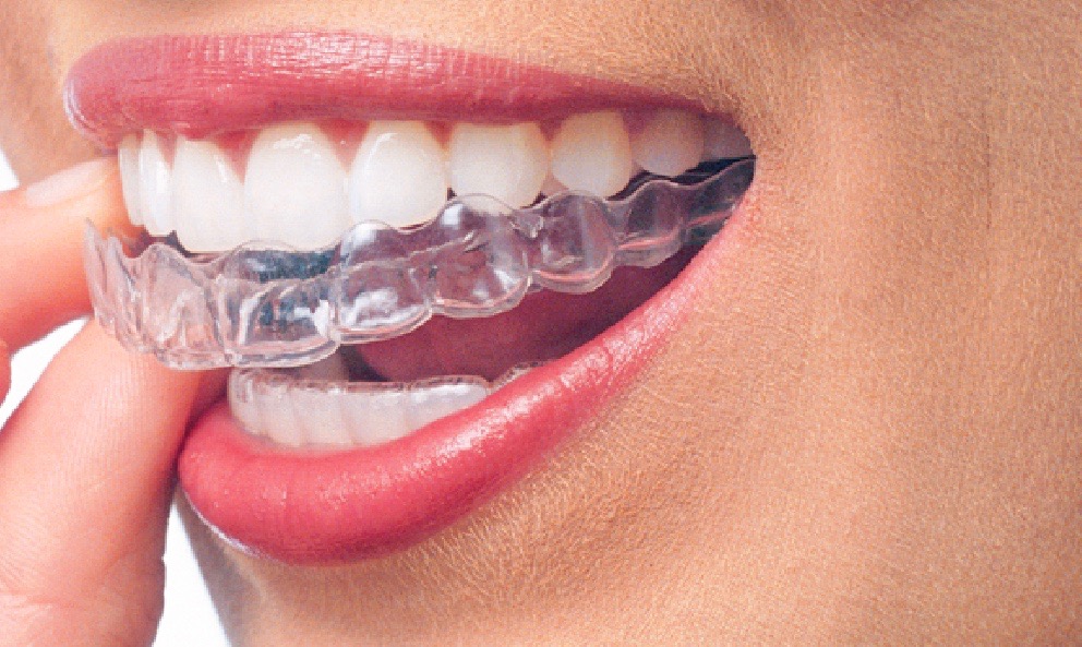 Teeth with Invisalign