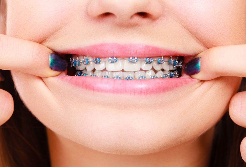 blue braces